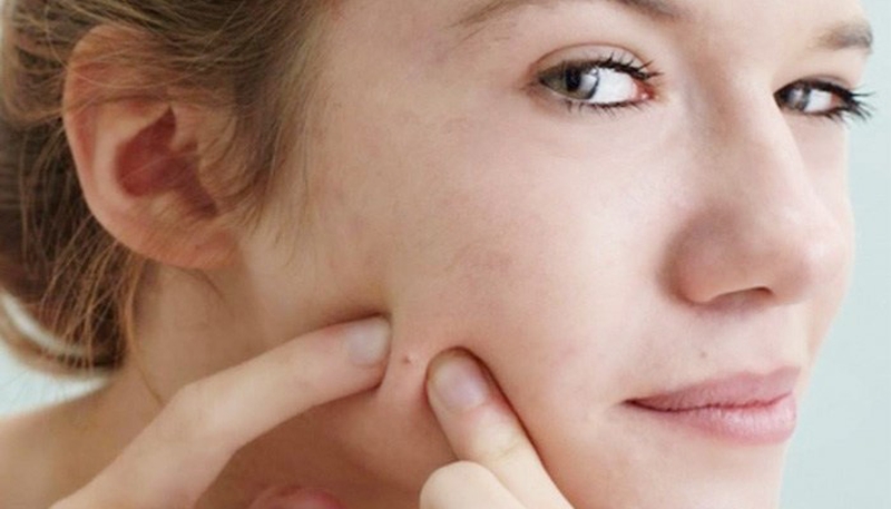 Dùng treatmnet bị lên mụn là do đâu 2