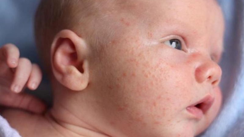 Tìm hiểu về dưỡng ẩm cho người viêm da cơ địa 1