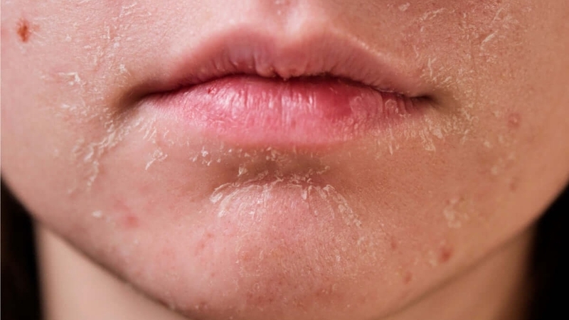 Dưỡng ẩm da mùa lạnh: Phương pháp và lưu ý khi chăm sóc da 1