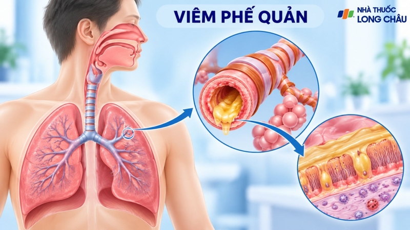 Viêm phế quản gây ho và có thể kèm đờm, thường liên quan đến nhiễm virus