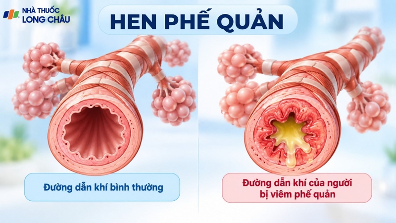 Hen phế quản gây viêm và co hẹp đường thở, dẫn đến khò khè và khó thở