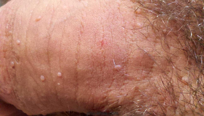 Dương vật nổi mụn đỏ