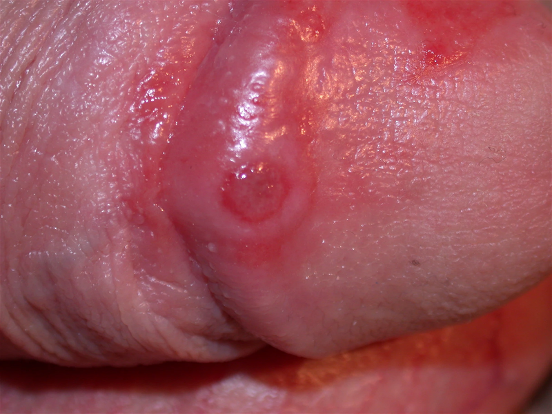 Dương vật nổi mụn đỏ