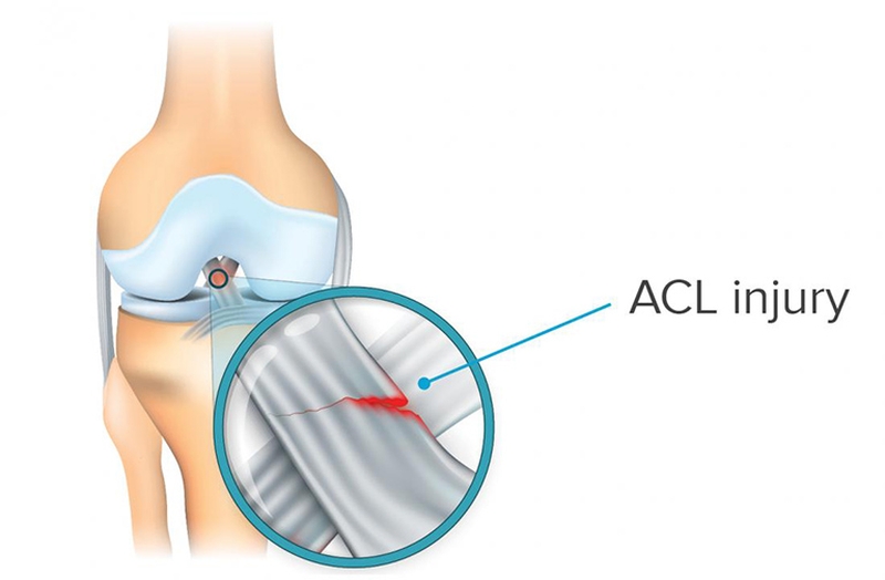 Cơ chế không tiếp xúc là nguyên nhân chủ yếu gây chấn thương đứt bán phần dây chằng chéo trước