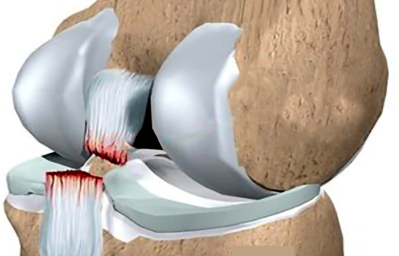 Đứt dây chằng chéo sau ít gây đau và ổn định hơn so với chấn thương dây chằng chéo trước