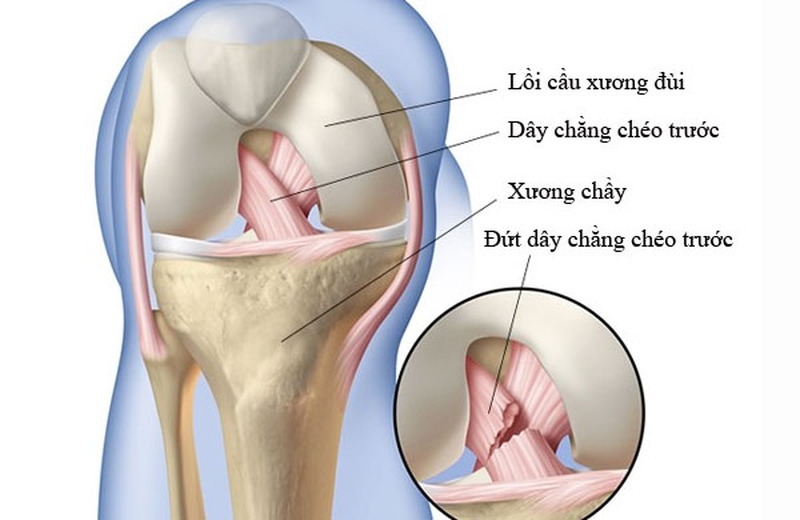 Đứt dây chằng chéo trước là tình trạng dây chằng chéo trước giữ vai trò ổn định khớp gối bị đứt