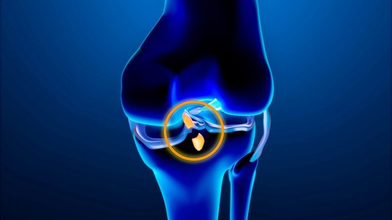 Đứt dây chằng đầu gối có phải mổ không? Những điều bạn cần biết 1