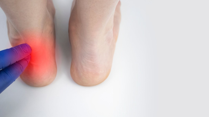 Sưng nề và đau quanh vùng gót chân là dấu hiệu nhận biết tình trạng đứt gân gót chân