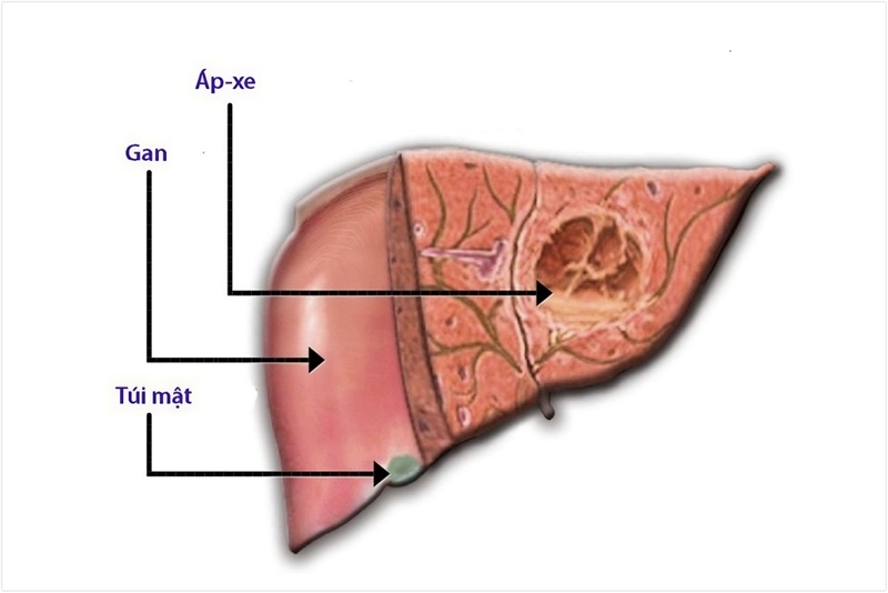 E. histolytica: Nguyên nhân gây nên bệnh lỵ 2