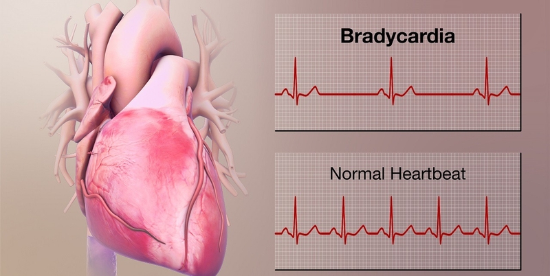 ecg-thieu-mau-co-tim-phuong-phap-chan-doan-va-dieu-tri-benh-hieu-qua 2.jpg