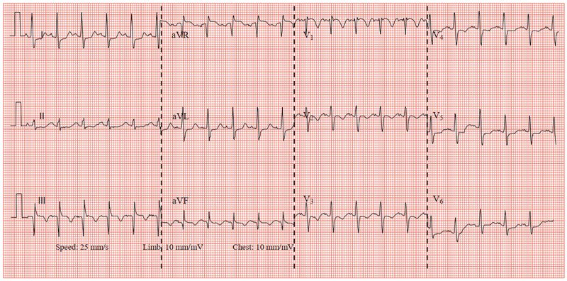ECG là loại đồ thị ghi lại những tín hiệu điện của tim