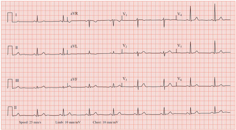 ECG trong thuyên tắc phổi có vai trò quan trọng trong chẩn đoán phát hiện hay loại trừ thuyên tắc