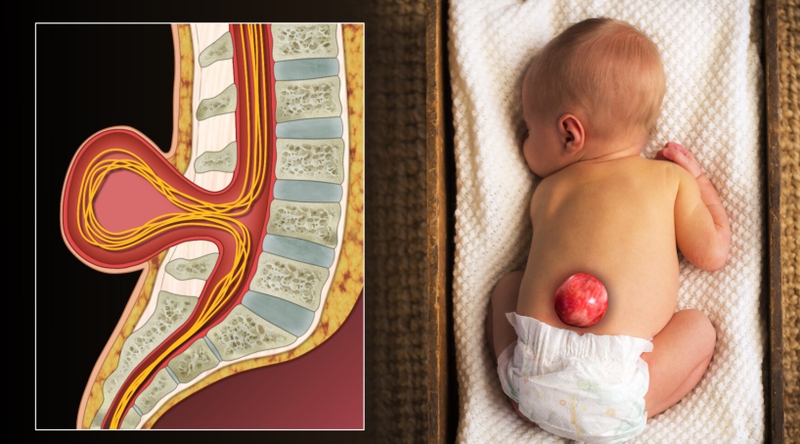 Em bé có vết lõm gần hậu môn là bệnh gì?