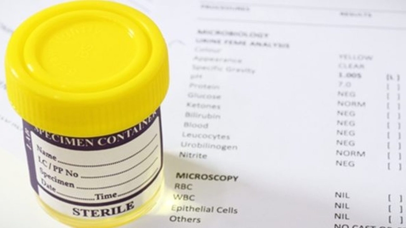 Epithelial cells là gì trong xét nghiệm nước tiểu?-1