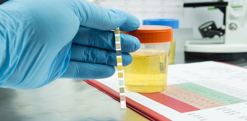 Epithelial cells là gì trong xét nghiệm nước tiểu?-2