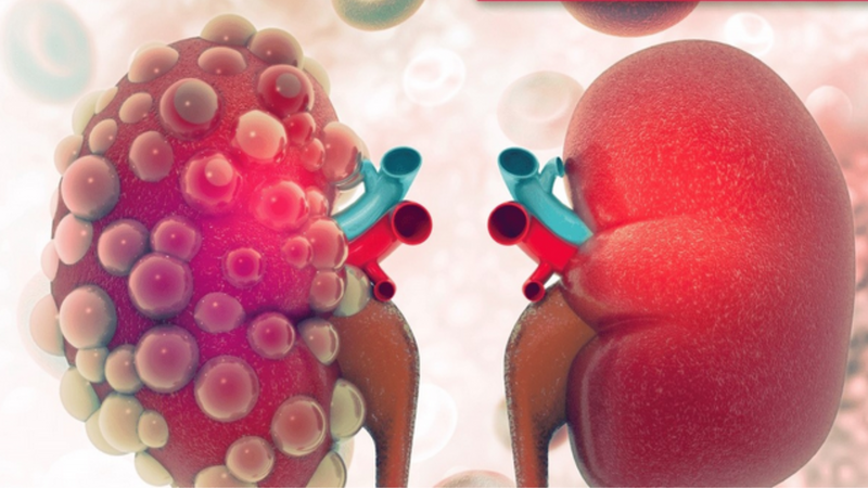 ESRD là gì? Biến chứng của ESRD là gì? 1