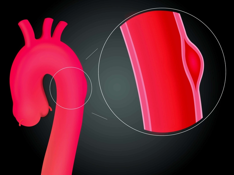 boc-tach-dong-mach-chu-la-gi-trieu-chung-nguyen-nhan-va-bien-phap-phong-benh 3