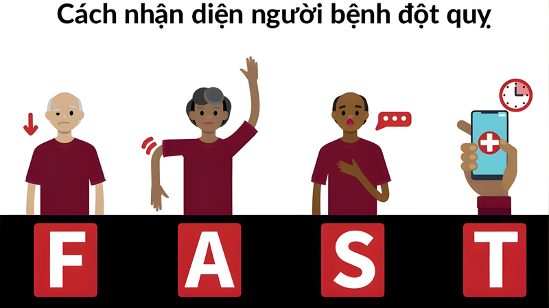 Nhận biết đột quỵ trong 60 giây với quy tắc FAST, đừng bỏ lỡ “thời gian vàng”