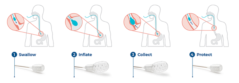 FDA phê duyệt xét nghiệm sàng lọc Barrett thực quản với thiết bị EsoCheck™ 4
