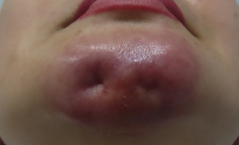 Filler Dermalax: Giải pháp xóa mờ nếp nhăn 6