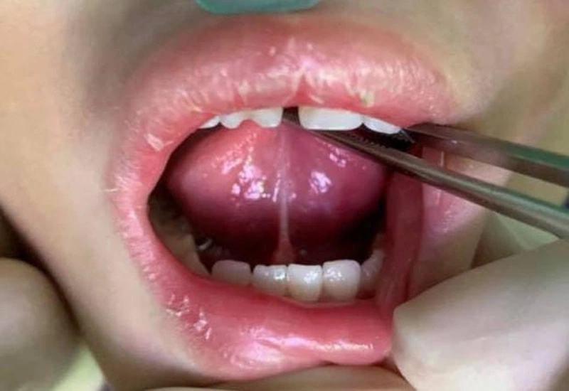 Điều trị tật dính thắng lưỡi độ 4 như thế nào? 3