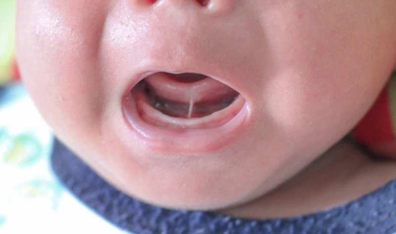 Điều trị tật dính thắng lưỡi độ 4 như thế nào? 2