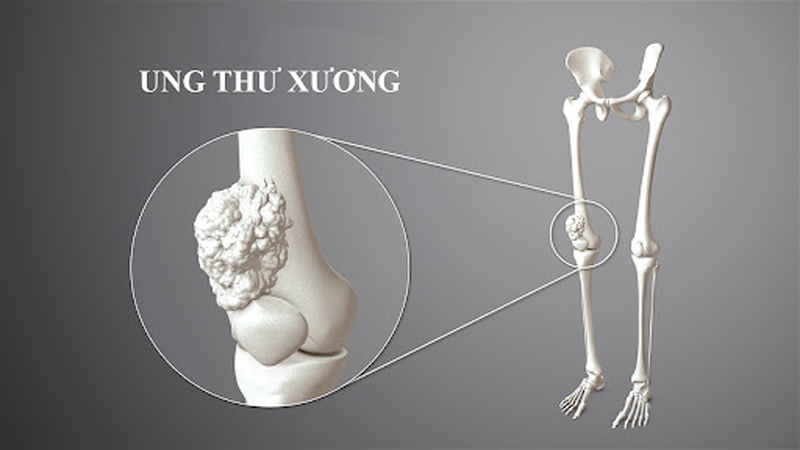 Sarcoma xương (U xương ác tính) ở trẻ em và thanh thiếu niên: Giới thiệu 3