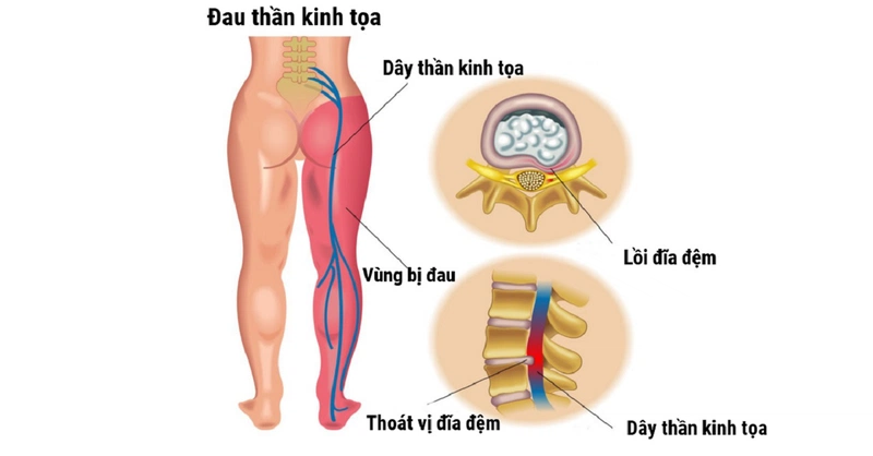 10 bệnh cột sống thường gặp mà bạn nên biết để phòng tránh 2