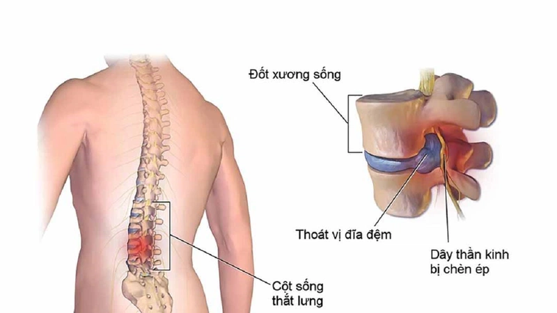 10 bệnh cột sống thường gặp mà bạn nên biết để phòng tránh 1