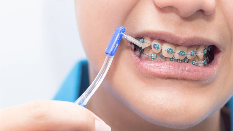 Khi ăn uống xong, bạn nên chải răng lại để đảm bảo mảng bám và mảnh vụn thức ăn không đọng lại
