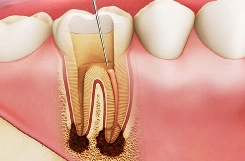 Răng lấy tủy có bị tiêu xương không? 3