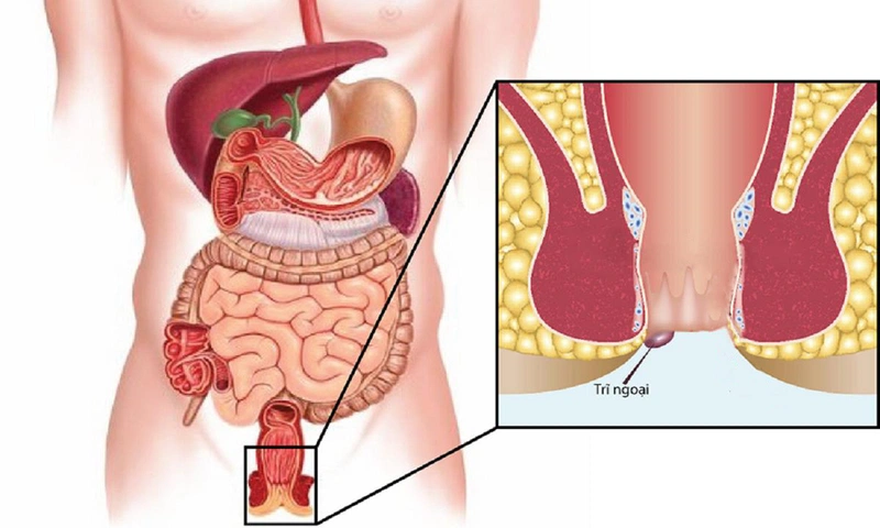 Thuốc Preparation H làm trơn niêm mạc ống hậu môn và giảm sưng, đau, sa búi trĩ sau khi đi đại tiện