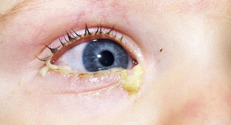 Nguyên nhân và biểu hiện của mắt bé bị đổ ghèn khi ngủ dậy 1