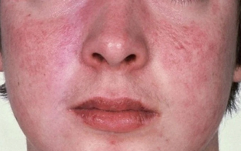 Nguy hiểm tiềm ẩn với bệnh lý lupus ban đỏ sau sinh 1