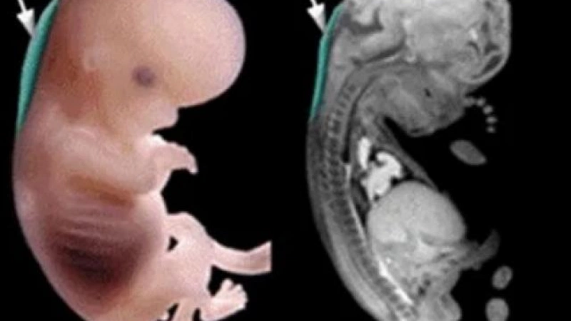 Thai 11 tuần đo độ mờ da gáy được chưa? 2
