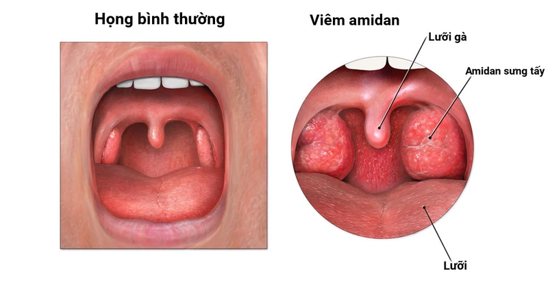 Phương pháp điều trị viêm amidan cấp và mạn tính - Nhà thuốc FPT ...