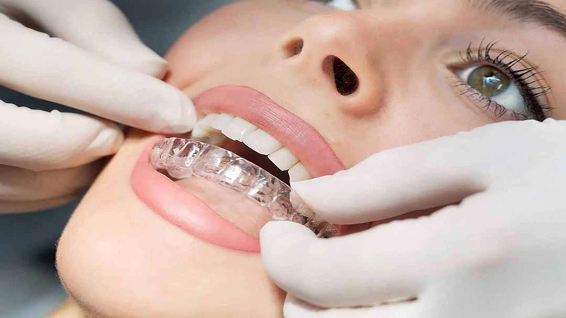 Nếu muốn răng thẳng nhanh chóng, bạn nên ưu tiên giải pháp niềng răng mặt trong bằng Invisalign