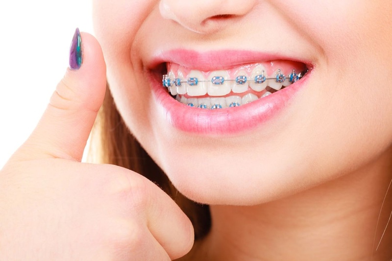 Chi phí niềng răng ở độ tuổi 16 bao nhiêu là nỗi băn khoăn, đắn đo của nhiều người khi cân nhắc niềng răng