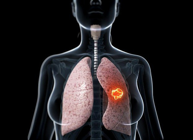 Ung thư phổi thứ phát và những điều bạn cần biết về nó 1