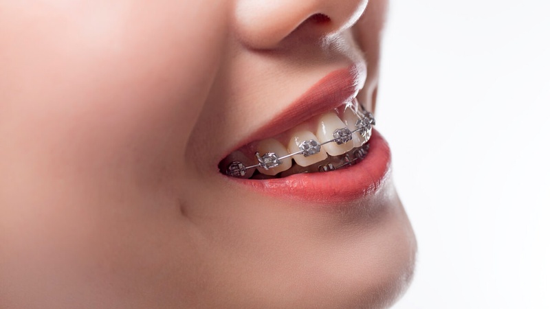 Niềng răng chỉnh nha tốn nhiều thời gian hơn so với các giải pháp điều trị răng thẩm mỹ khác