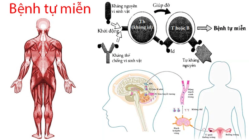 Lupus ban đỏ và vảy nến: Tổng quan và các triệu chứng 1