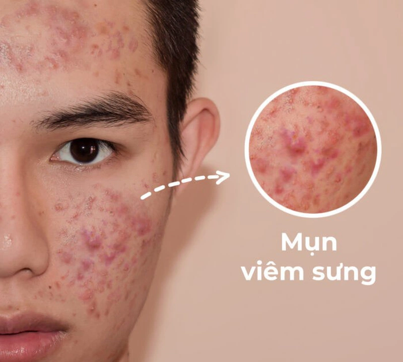 Decumar có trị mụn viêm không? 1