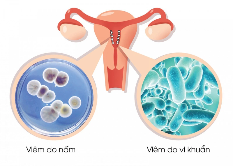 Dấu hiệu viêm nhiễm phụ khoa thường gặp ở phụ nữ 1