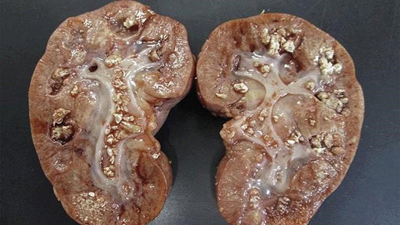 Biến chứng của bệnh gout mà mọi người cần lưu ý 2
