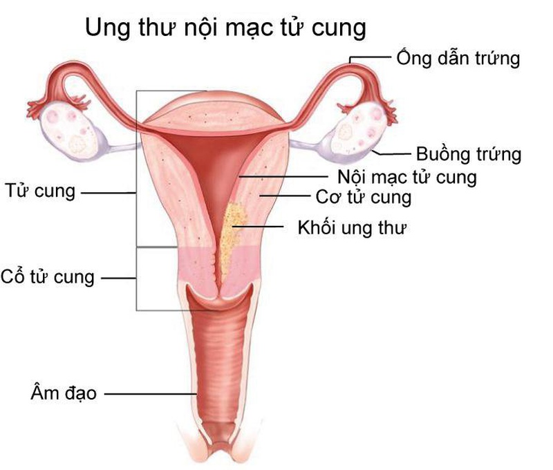 Các thắc mắc về ung thư nội mạc tử cung3