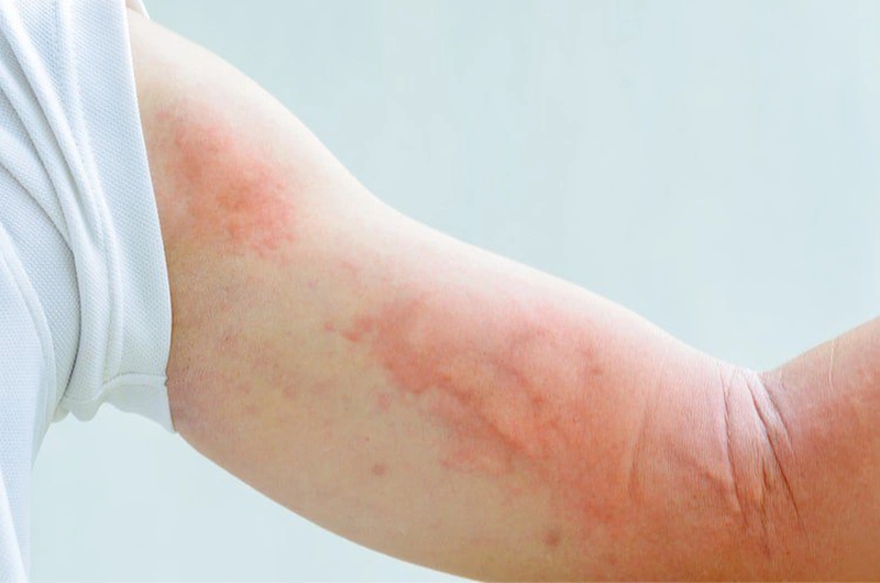 Một số người có thể bị sốc phản vệ khi bi dị ứng kem đánh răng