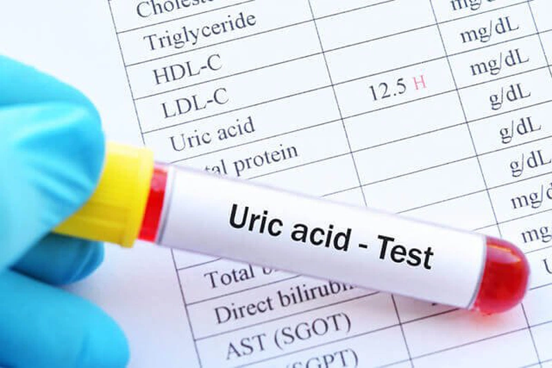 Làm thế nào để kiểm soát chỉ số bệnh gout? 1