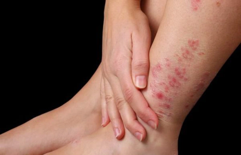 6 mẹo chữa viêm da cơ địa bằng lá lốt bạn nên biết 1