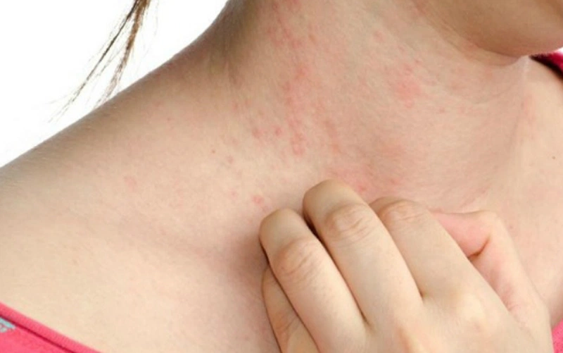 Dấu hiệu cho thấy bạn bị dị ứng với rượu vang 2