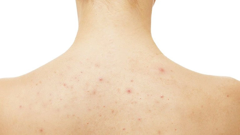 Nacurgo gel trị viêm nang lông hiệu quả không?